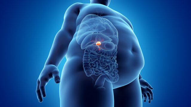 3d rendered illustration of an obese mans gallbladder