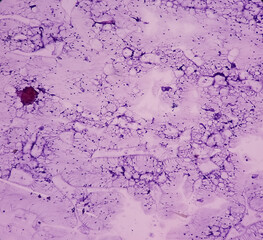 Breast lump(biopsy): Fat necrosis, injury of fatty tissue, show fragments of fatty tissue, foamy histiocytes, giant cells and inflammatory cells, benign condition.