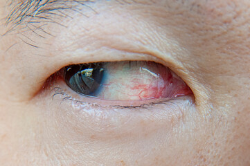Close-up Asian man eye with eye irritation