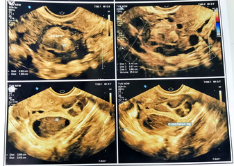 Film Ultrasound, ovarian cysts,Internal organs examination for women