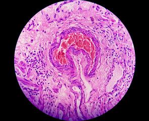 Microscopic image of an atypical proliferative (borderline) serous tumor of the ovary (low...