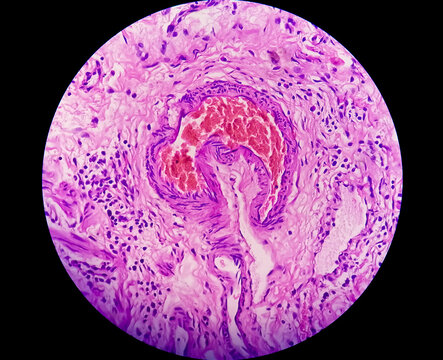 Microscopic image of an atypical proliferative (borderline) serous tumor of the ovary (low malignant potential) with branching papillae lined by stratified cells with nuclear atypia.