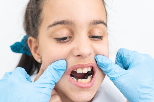 Dentist is check and set dimension of brackets. Talking to girl about braces in her mouth
