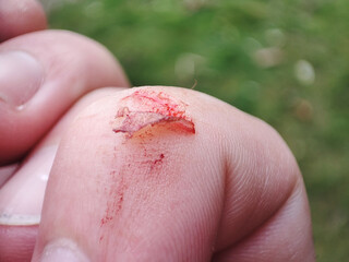 Injured finger with bleeding open cut. Deep wound. the injured finger with a dirty open background