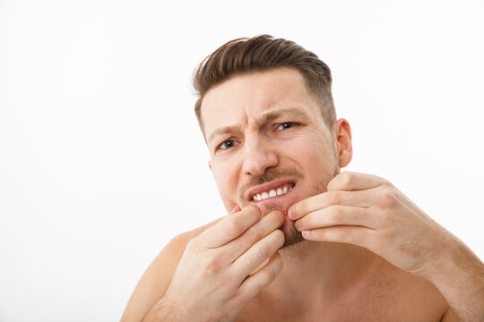 A young man squeezes out a pimple on his face while looking in the mirror. Problematic skin.