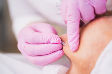 Thread lifting is a minimally invasive procedure for tightening the skin of the face and body using special reinforcing threads 