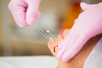 Thread lifting is a minimally invasive procedure for tightening the skin of the face and body using...
