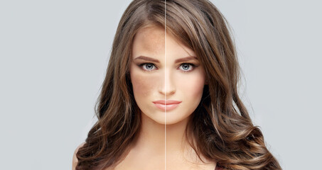 Fototapeta premium Dark spots, freckles,hyperpigmentation(melasma or chloasma),concept- skin lightening, skin whitening, Skin Brightening