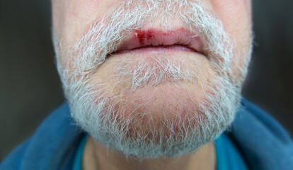 Fever blister caused by herpes simplex virus on upper lip of elderly bearded man
