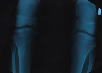 knee X-Ray, realistic scan, vector illustration