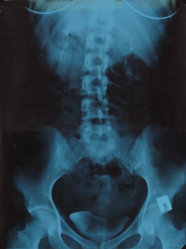 Realistic Lumbar spine x ray, pelvic bones MRI scan picture. Vector illustration