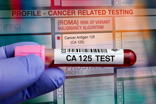 Blood tube test with requisition form for Cancer risk CA 125 ROMA test. Blood sample tube for analysis of Tumor Marker Risk Ovarian Malignancy profile test in laboratory