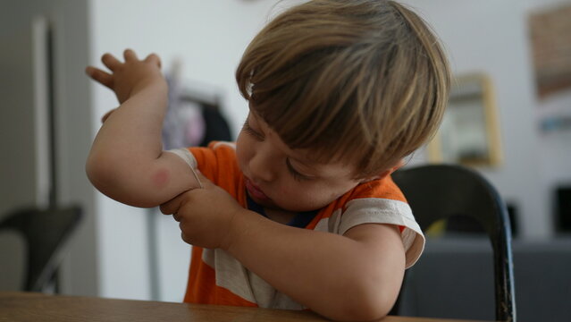 Kid showing mosquito bite child shows insect bite in arm