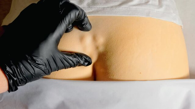Fracture of the coccyx of the spine. External medical exam by a doctor. Gloved hands show trauma. The sacrum and coccyx protrude and are clearly visible. Female patient.