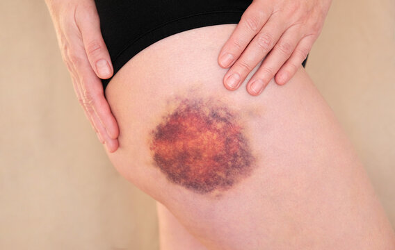 Hematoma on a woman's leg close up. Huge bruise on the leg of a woman.