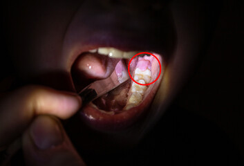6 year old child with gum flap over child molar.  - https://t4.ftcdn.net/jpg/04/87/61/13/240_F_487611382_WeEswIX9HS9HgqQjbpJcrJvI5jjgjiz4.jpg