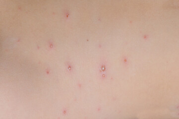 Chickenpox on the skin of a child close-up.