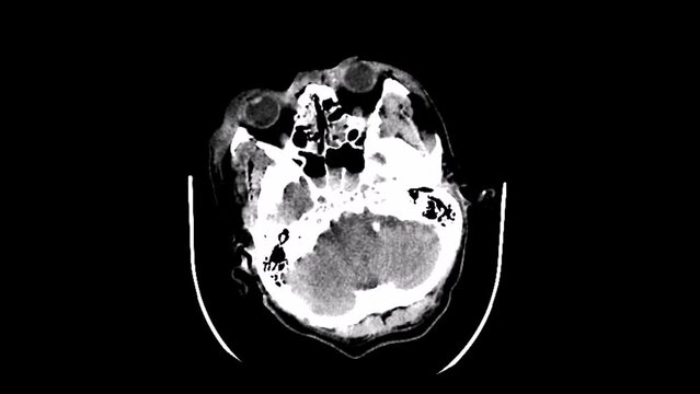 axial head ct scan image of contusional hemorrhage frontal lobe
