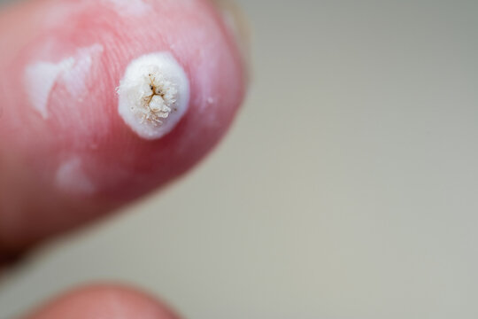 Closeup of warts on skin of fingers. Large white warts.