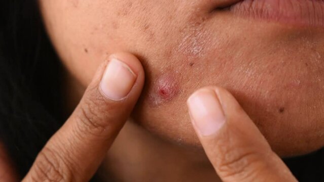 A Girl pressing pimple on her face closeup