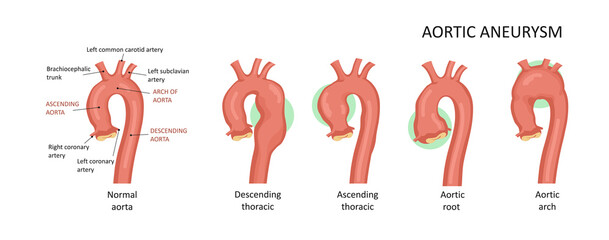 Types of aortic aneurysms: root, ascending, descending,arch.