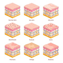 3d human skin types cross section layers. Dry, oily and normal epidermis. Skin problems, acne, blackheads, psoriasis and vitiligo vector set - obrazy, fototapety, plakaty