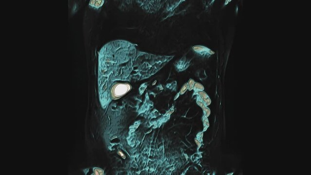 Bulk multicolored CT scan of the abdomen. Computed tomography of the gastrointestinal tract, liver and kidneys
