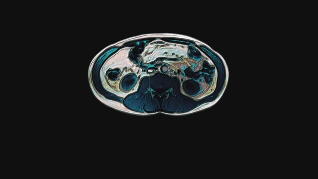Bulk multicolored CT scan of the abdomen. Computed tomography of the gastrointestinal tract, liver and kidneys