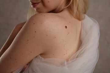 Checking benign moles : Beautiful Woman with birthmark on her back. and face. Laser skin tags...