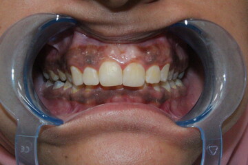 gum pigmentation