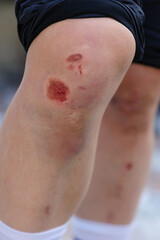 Fototapeta premium Sports injury, skateboarder with injured knees