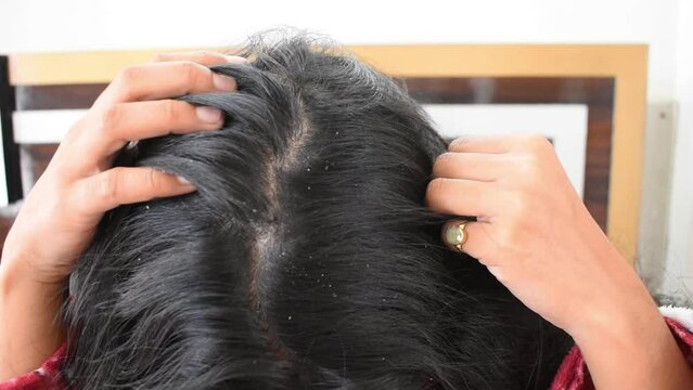 Woman's hair top view with dandruff