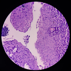 Chronic tonsillitis: Microscopic image of tonsillar tissue, show lymphoid follicles of different size, shape and lined by stratified squamous epithelium. No malignancy seen