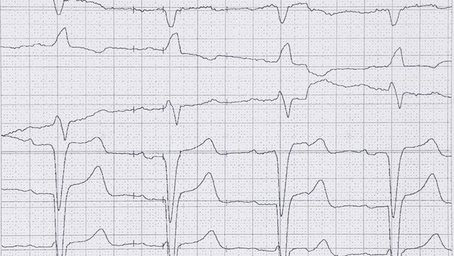 Cardiogram charts on white paper close up