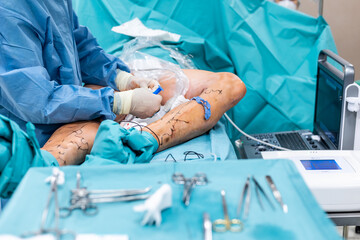 Surgery of varix or varicose a vein, vascular medicine, healthcare concept