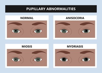 miosis eye pupil size iris retina brain Horner miotic muscle dilated ocular injury ptosis reflex Marcus Gunn defect optic nerve test palsy Trauma birth Adie tonic argyll hutchinson blind diplopia exam