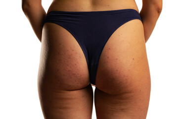woman's buttocks with problematic skin and pimples and cellulite