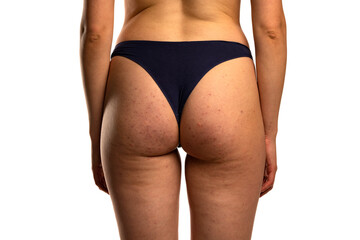 woman's buttocks with problematic skin and pimples and cellulite