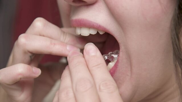 Mouth close-up A young woman puts a corrective aligner splint on her lower teeth to correct an overbite while looking in the bathroom mirror. Installation of aligners