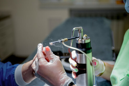 The doctor makes the patient cryotherapy procedure. Close-up of the patient's hand and wounded fingers.