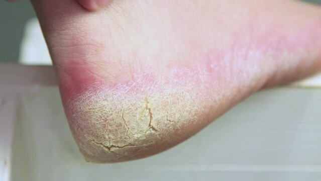 Fingers massage the cracked heel with rough skin on the leg. We do the pedicure ourselves. Self-care for your feet. Isolated video, close-up. Warm, soft light. UHD 4K.