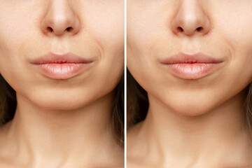 Сhin reduction. Cropped shot of woman's face with chin before and after mentoplasty. The result of...