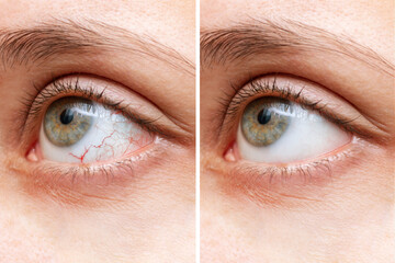 Close-up of female eye with red inflamed and dilated capillaries before and after treatment. The...