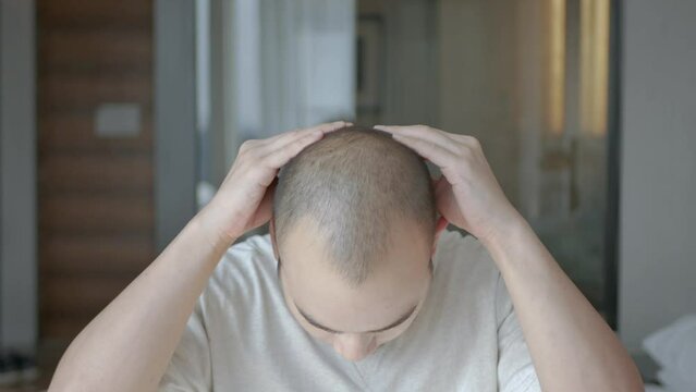 POV to a yong asian man concerns about the hair on  his head, bald spots suffering from hair loss. Treatment of hair problem.