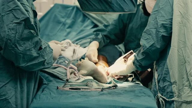 4k Slow motion, Assistant preparing instruments support Orthopedic doctor performing in plate and screw internal fixation on leg surgery patient in operating room. Operation medical surgery procedure.