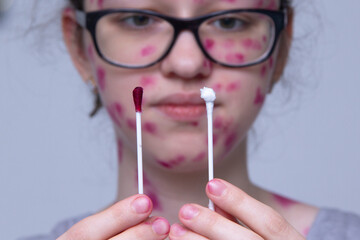 The skin rash in a child is treated with a cotton swab. Chickenpox virus. Skin rash and blisters on the body