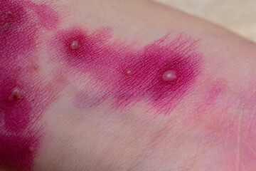 Close-up of a child's skin rash. Varicella zoster virus virus.