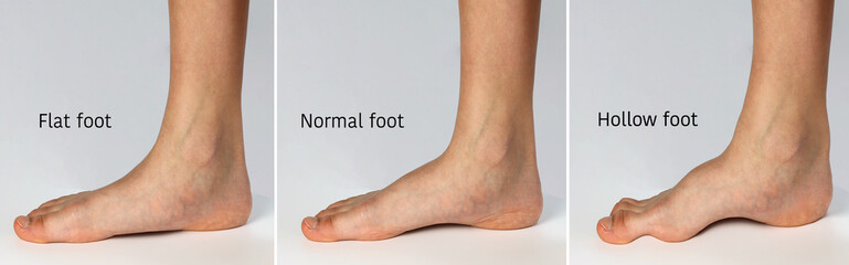 Chart showing forms of foot. Flat shape( fallen arch), Normal healthy foot and hollow shape (high...