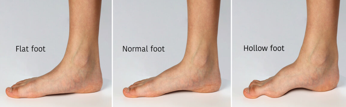 Chart showing forms of foot. Flat shape( fallen arch), Normal healthy foot and hollow shape (high arch) or claw foot isolated on white background.