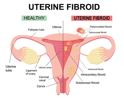 Types of uterine fibroids. Disease of the female reproductive system. Reproductive system picture displays pedunculated, intracavitary, submucosal, subserosal. Flat illustration of  myoma, leiomyomas.